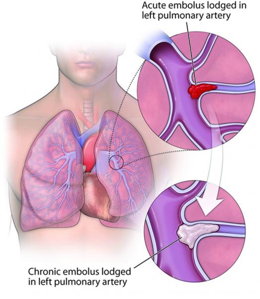 Chronic Thromboembolic Pulmonary Hypertension (CTEPH) | Temple Health