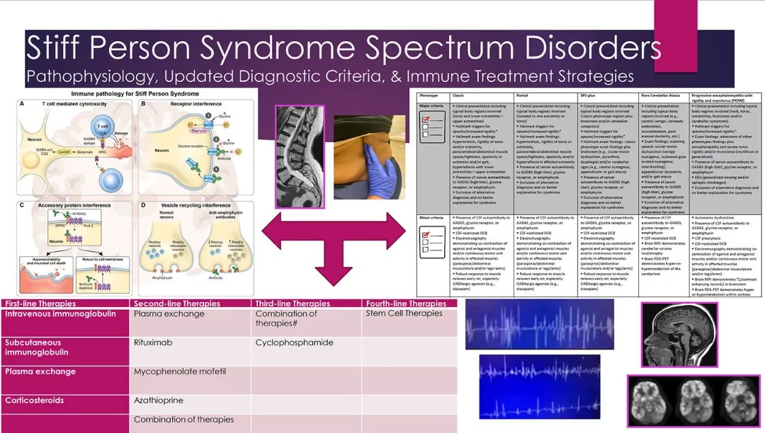 僵人综合征谱系障碍(Stiff person syndrome spectrum disorders，SPSD 