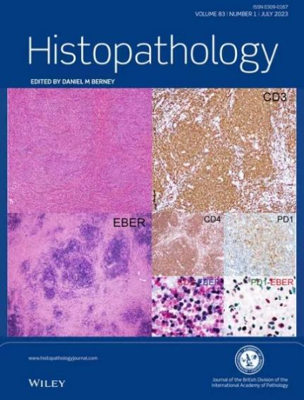 Histopathology：全球首次报告！EBV感染T细胞淋巴瘤又有新发现
