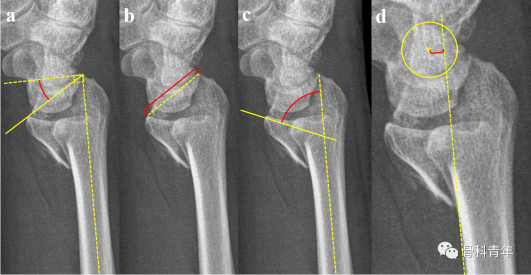 弧心距（arc center distance）：评估掌侧Barton骨折移位的影像参数