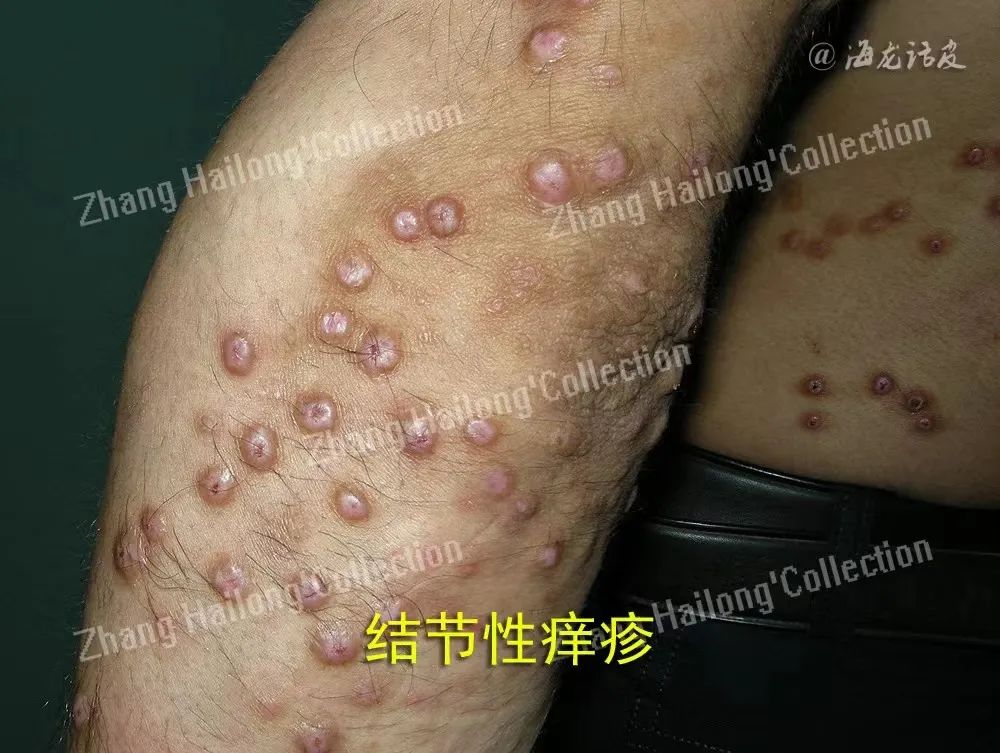 皮肤科常用免疫抑制剂-MedSci.cn
