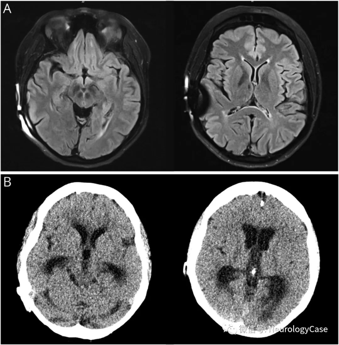 Neurology病例：神经结节病患者脑室腹腔分流障碍导致的Parinaud综合征