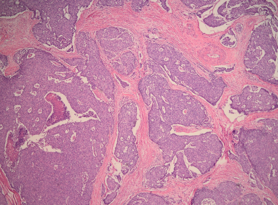 病例分享 | 宫颈大细胞神经内分泌癌