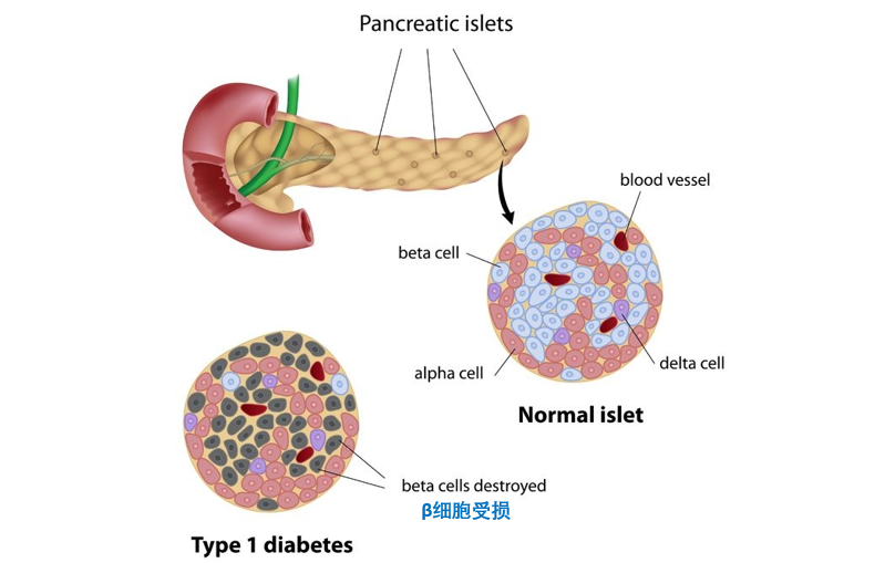 1型糖尿病是由胰岛β细胞受损,导致胰岛素分泌绝对不足造成的