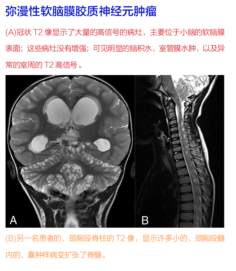 Neurology病例：一例罕见的儿童<font color="red">弥漫性</font><font color="red">软</font><font color="red">脑膜</font><font color="red">胶质</font><font color="red">神经元</font><font color="red">肿瘤</font>