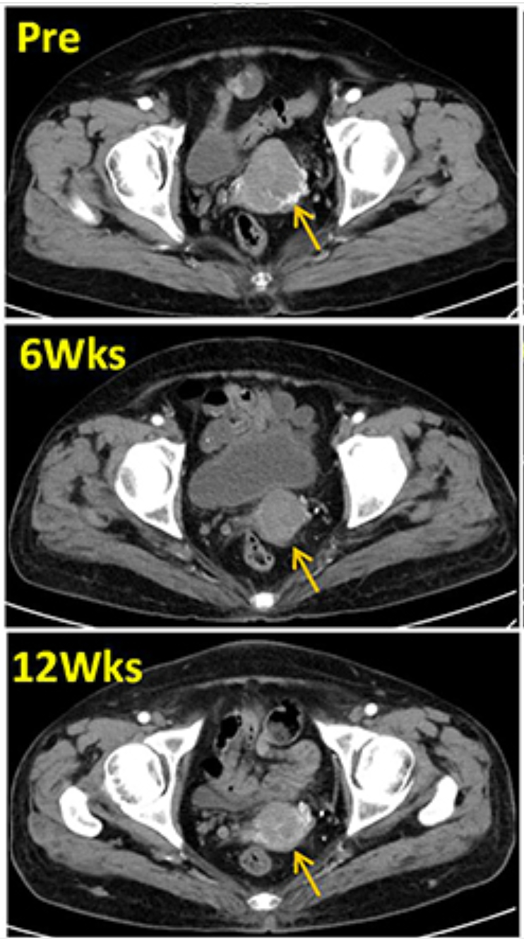 IJWH：自体肿瘤浸润淋巴细胞（<font color="red">TIL</font>）成功救治2例宫颈癌患者