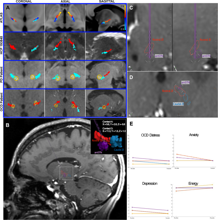 Biol. Psychiatry ：未定带（ZI）的扩散 MRI 纤维束成像指导：深部脑刺激的新目标