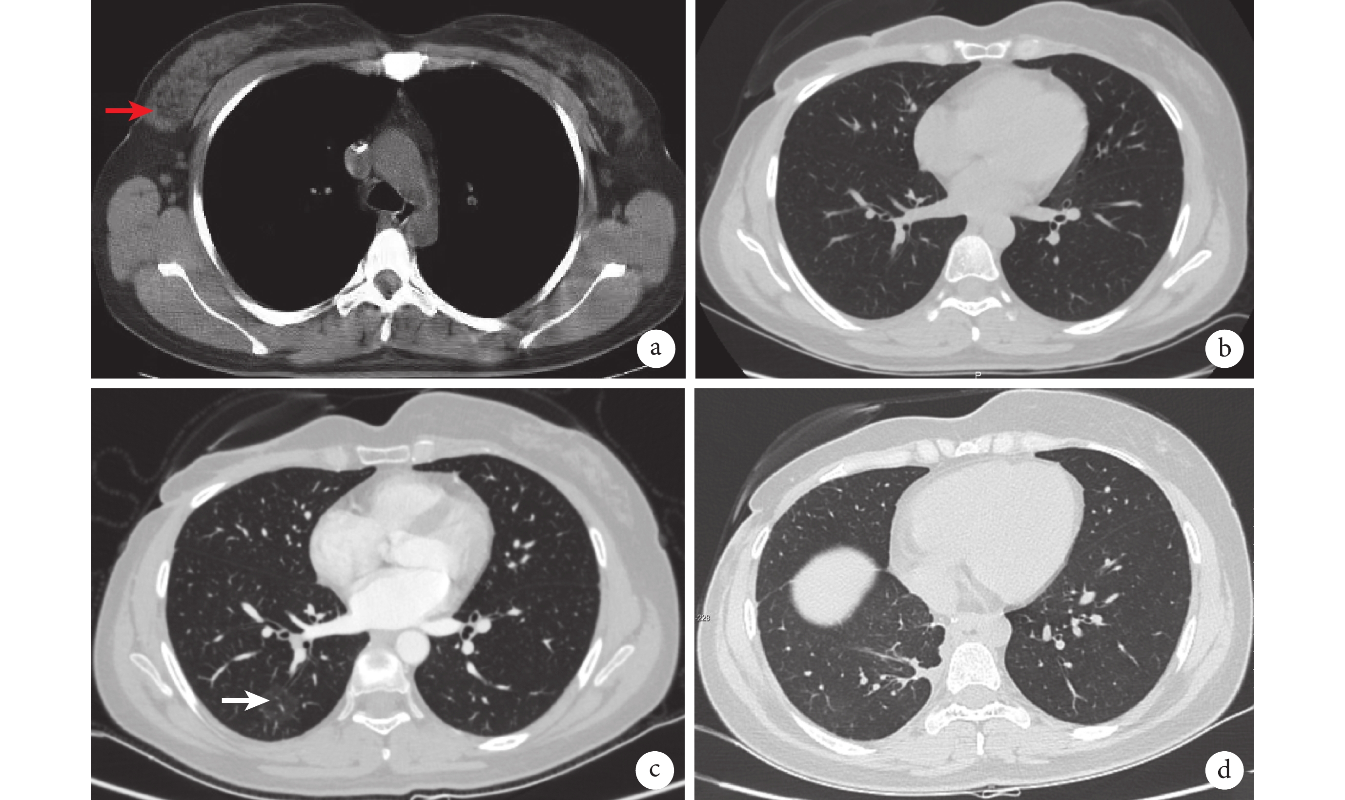 单<font color="red">发</font>纯磨玻璃结节为表现的肺转移癌一例