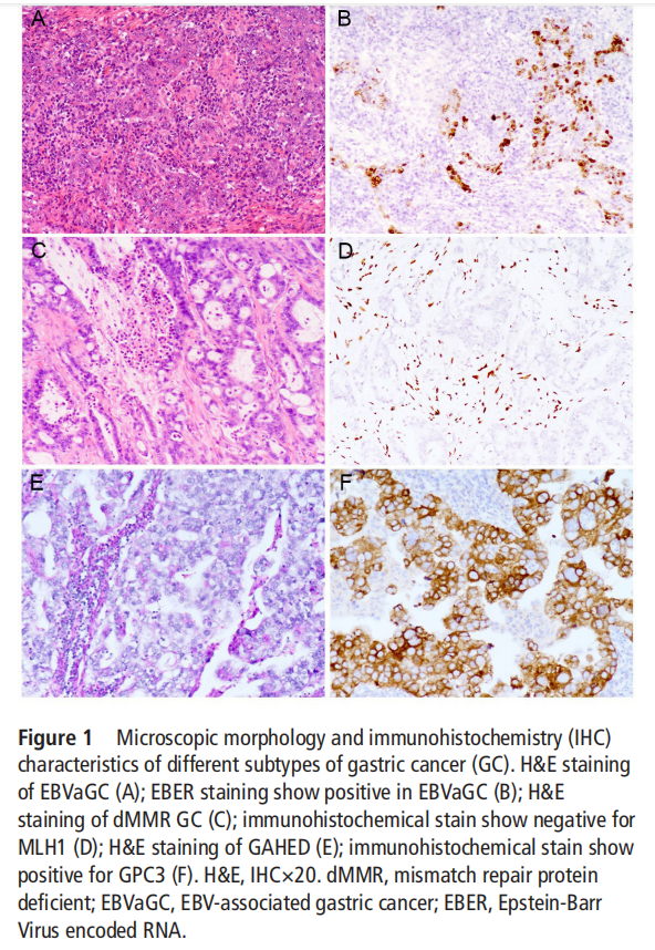 J Clin Pathol：NTRK基因改变在肝样胃癌中的特异性富集