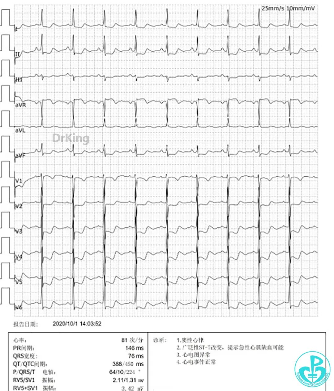 心电图提示avr导联st段抬高,v69～v64导联st段明显压低