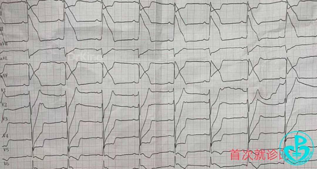 输液有风险"消炎"要谨慎—1例头孢引发的急性心梗