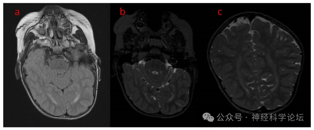 早发性难治性癫痫：警惕CDKL5缺乏症（CDD）@MedSci