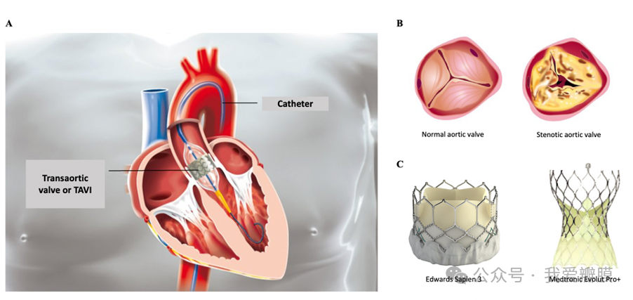 Transcatheter aortic valve implantation (TAVI) - Centre de Cardiologie ...