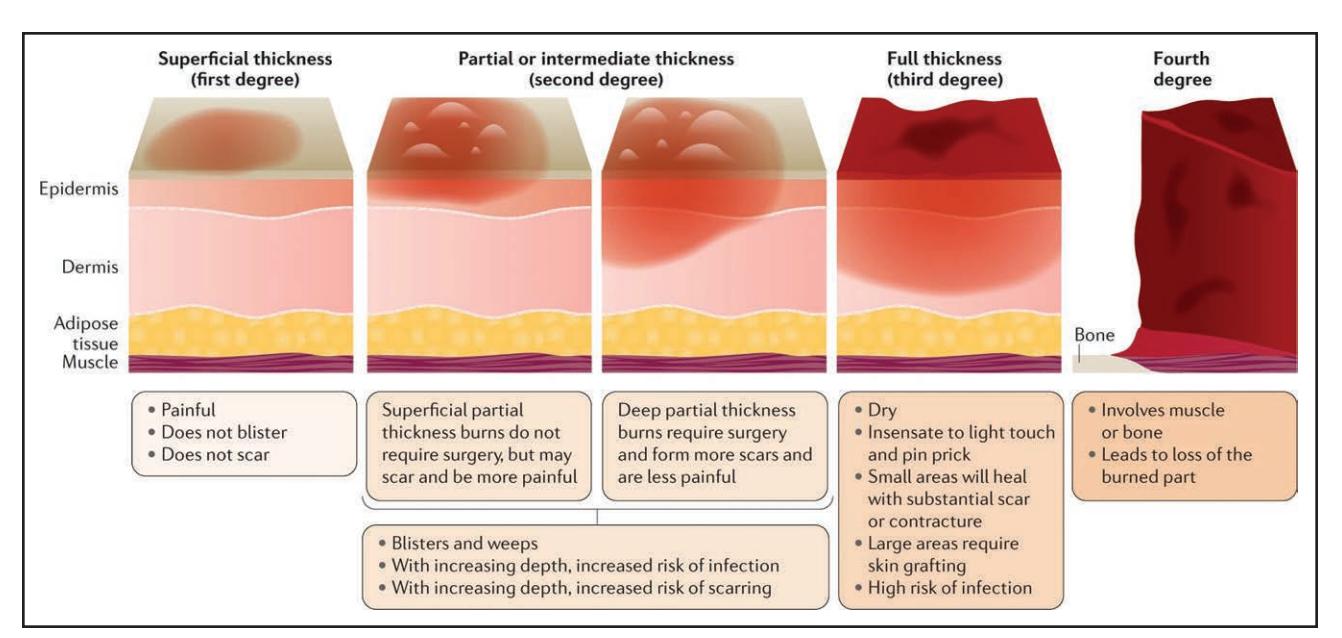 【2024 American Heart Association and American Red Cross Guidelines for First Aid】Burn depth classification diagram