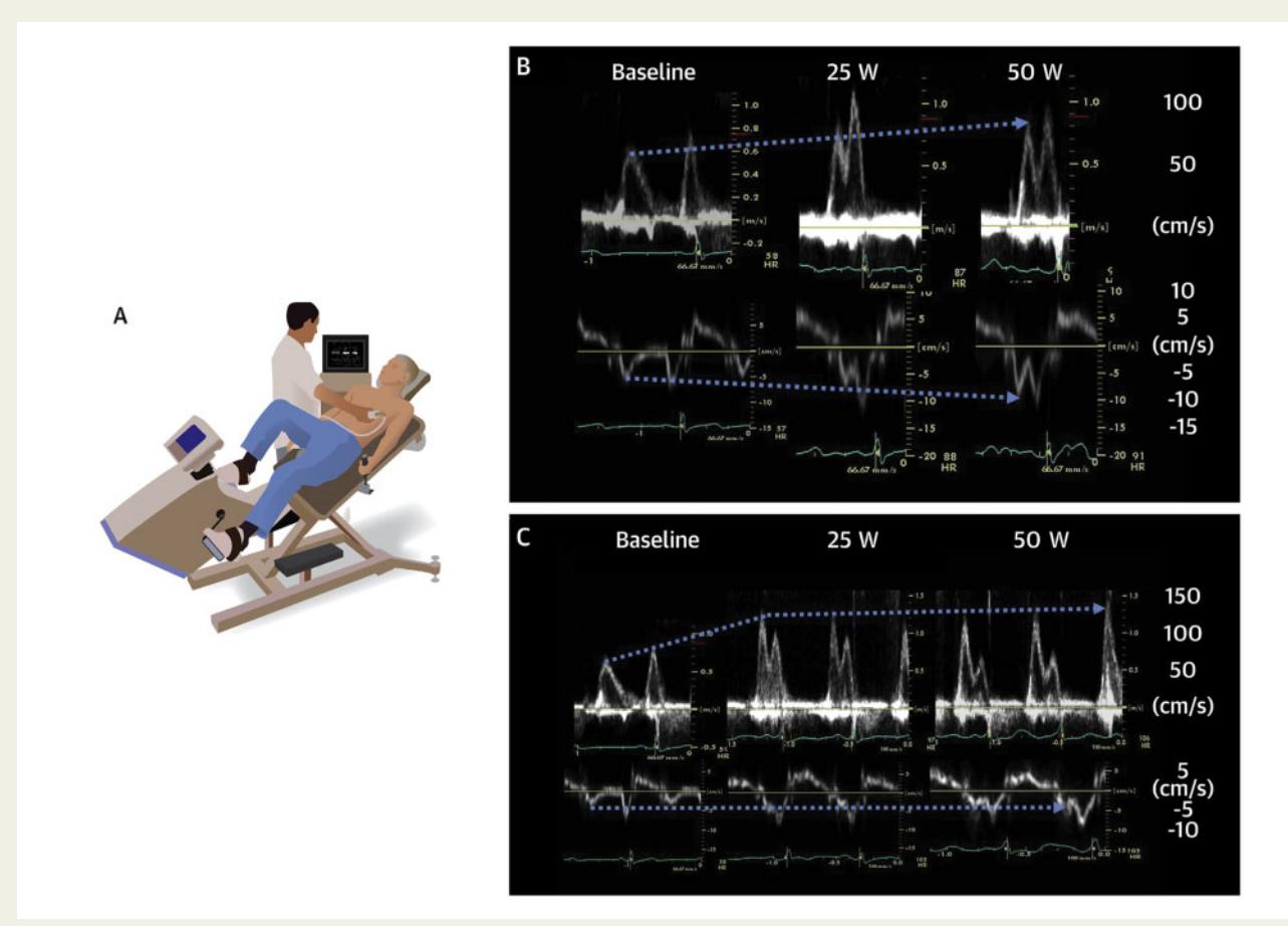 【半卧位运动负荷超声心动图设置】Stress Echocardiography Setup