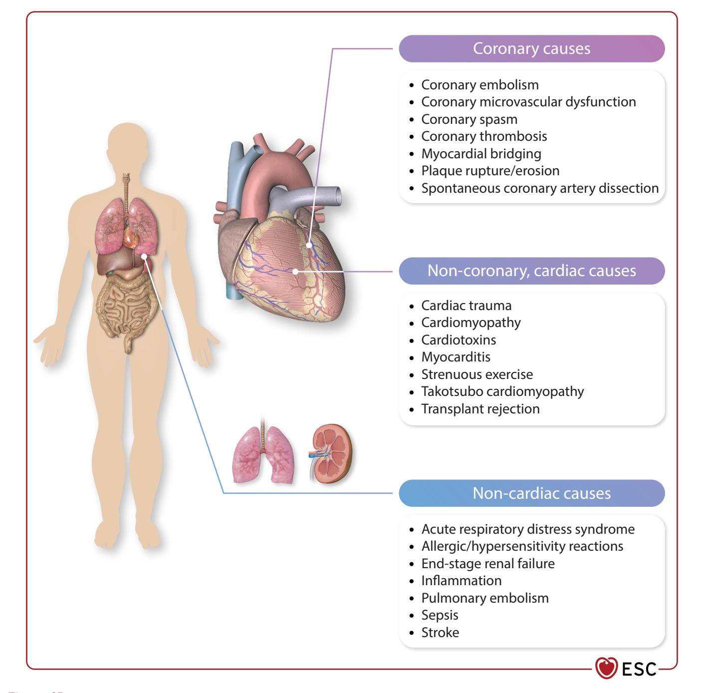 【2023 ESC Guidelines for the management of acute coronary syndromes: Developed by the task force on the management of acute coronary syndromes of the European Society of Cardiology (ESC)】Differential diagnosis diagram