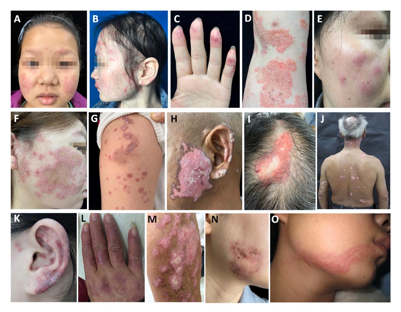 【Auto immune Disease Diagnosis】红斑狼疮皮肤表现临床照片