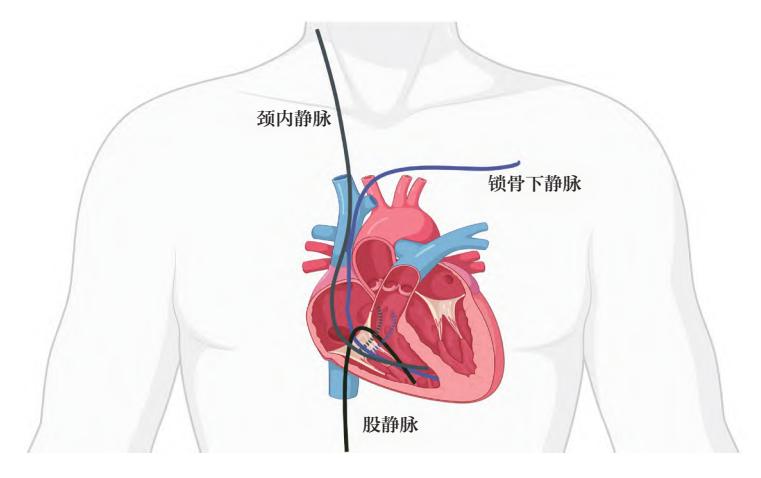 【解剖介入示意图】中心静脉入路示意图