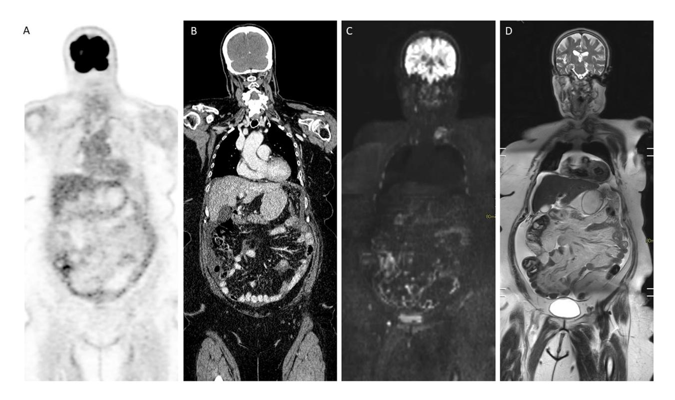 image_category: MEDICAL_IMAGING/PET/CT and MRI | body_region: whole body | specialty: Radiology | summary: Multi-modal whole-body imaging (PET, CT, DWI, MRI) demonstrating a large abdominal/pelvic mass, likely for oncological staging. | detail: This composite image presents four coronal views of a whole-body scan using different imaging modalities, labeled A through D. Panel A is a Positron Emission Tomography (PET) scan, likely using 18F-FDG, which shows metabolic activity. Notable findings include physiological high uptake in the brain and excretion in the urinary bladder, along with diffuse, heterogeneous uptake within the abdominal cavity. Panel B is a coronal Computed Tomography (CT) scan providing detailed anatomical context; it reveals a significantly distended abdomen containing a large, complex mass or extensive fluid collection that displaces the liver and bowel loops. Panel C is a Diffusion-Weighted Imaging (DWI) sequence or a PET-MIP, highlighting areas of restricted water diffusion or high metabolic turnover, which correlates with the abdominal findings in the other modalities. Panel D is a T2-weighted Magnetic Resonance Imaging (MRI) coronal section, offering superior soft-tissue contrast. It clearly delineates the boundaries of the abdominal/pelvic pathology, showing its relationship to the diaphragm, liver, and pelvic floor. The integration of these modalities is crucial for the clinical evaluation of complex oncological cases, such as staging a large primary tumor or assessing the extent of peritoneal carcinomatosis. The key data points include the presence of a large-volume abdominal process with associated metabolic activity and restricted diffusion, suggesting an aggressive neoplastic process. | entities: diseases=abdominal mass, pelvic mass, malignancy, peritoneal carcinomatosis; anatomical_structures=brain, heart, liver, abdomen, pelvis, bladder, diaphragm; interventions=PET/CT scan, MRI scan, DWI; biomarkers=18F-FDG; findings=high FDG uptake in brain, large abdominal mass, distended abdomen, heterogeneous metabolic activity in abdomen, restricted diffusion in abdominal region