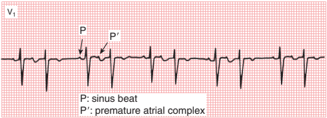 【Goldberger's Clinical Electrocardiography】房性早搏伴右束支传导阻滞差异性传导