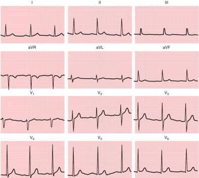 【Goldberger’s Clinical electrocardiography, A simplified approach】Left Ventricular Hypertrophy