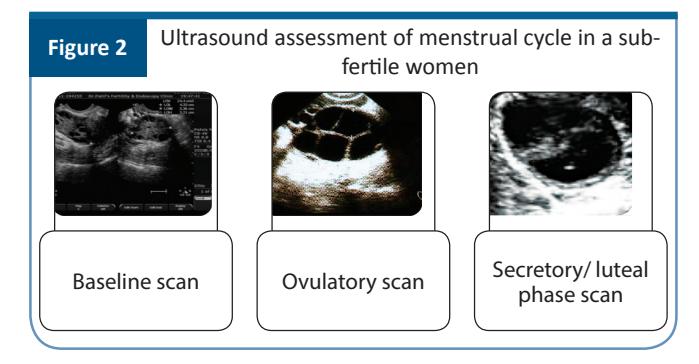 【超声图像】亚生育女性月经周期的超声评估:基线扫描、排卵期扫描和分泌期/黄体期扫描