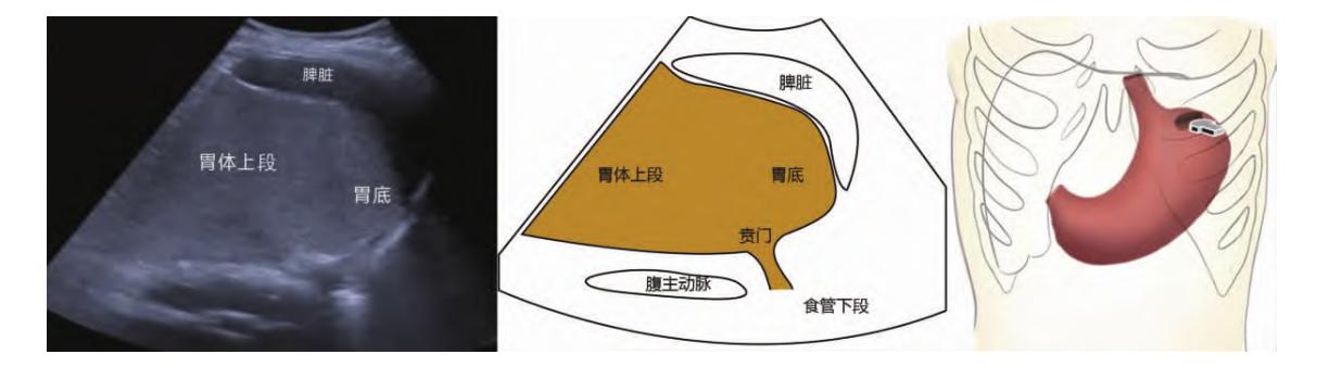 【胃部超声影像及示意图】胃体上段、胃底及贲门区域超声影像