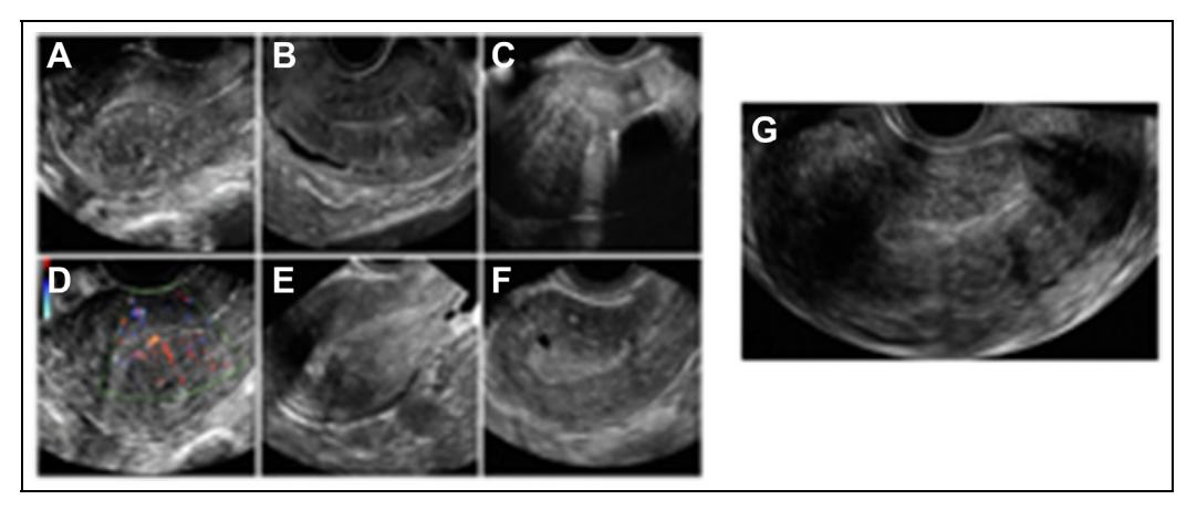 【Guideline No. 437: Diagnosis and Management of Adenomyosis】Transvaginal Ultrasound (TVUS)