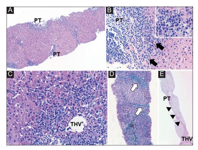 【Hellenic Association for the Study of the Liver (HASL): revised clinical practice guidelines for autoimmune hepatitis】Histopathology