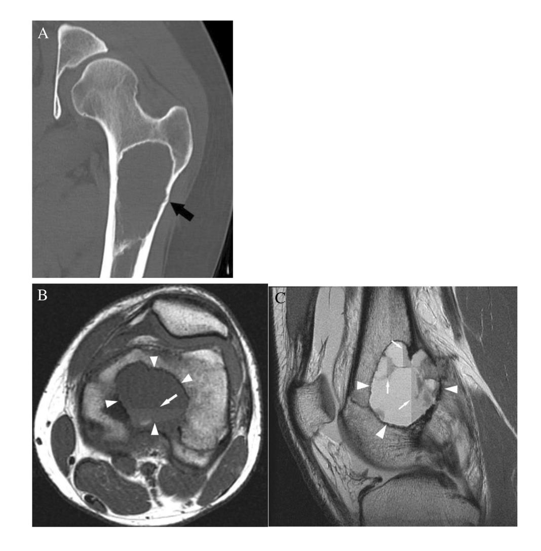 CT and MRI images demonstrating expansile lytic bone lesions with characteristic fluid-fluid levels, highly suggestive of an aneurysmal bone cyst