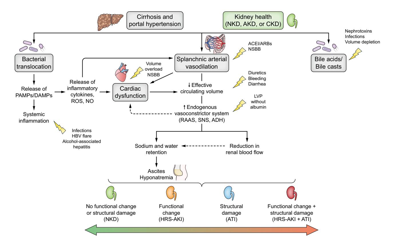 【肝肾综合征病理生理机制流程图】HRS Pathophysiology