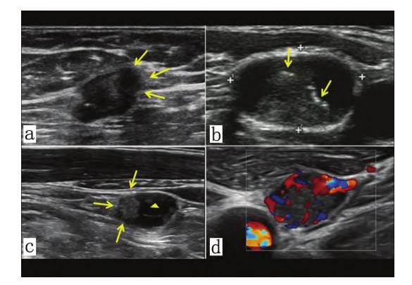 image_category: MEDICAL_IMAGING/超声影像 | body_region: 颈部 | specialty: 超声科 | summary: 颈部异常淋巴结的超声多模态表现,提示转移性病变特征。