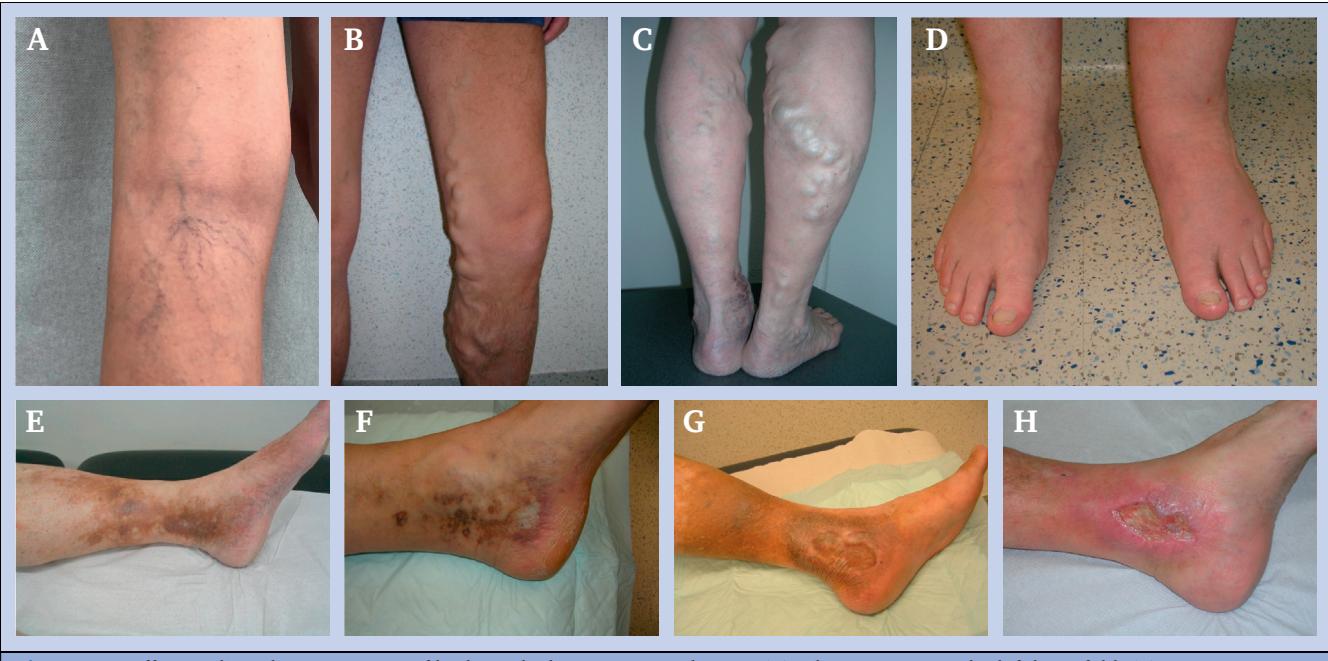 【European Society for Vascular Surgery (ESVS) 2022 Clinical Practice Guidelines on the Management of Chronic Venous Disease of the Lower Limbs】Clinical photographs