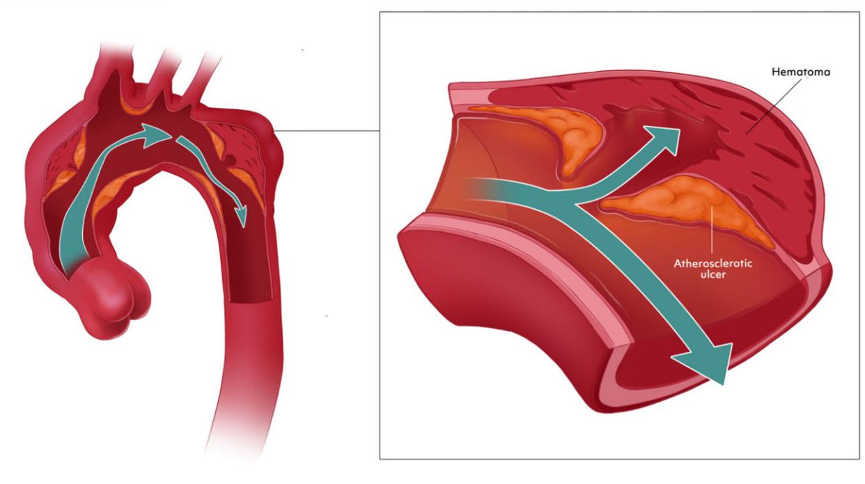 image_category: DIAGRAM/Pathophysiology Illustration | body_region: chest | specialty: Vascular Surgery | summary: This illustration depicts the development of a penetrating aortic ulcer (PAU) and the resulting formation of an intramural hematoma (IMH) within the aortic wall.