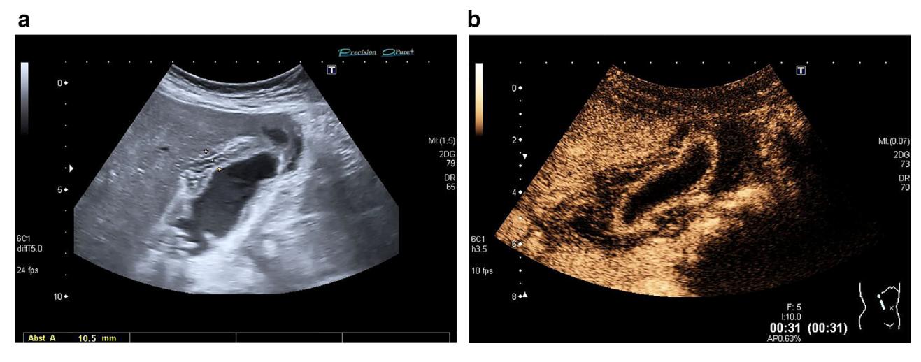 【Incidental Findings of Gallbladder and Bile Ducts-Management Strategies: General Aspects, Gallbladder Polyps and Gallbladder Wall Thickening-A World Federation of Ultrasound in Medicine and Biology (WFUMB) Position Paper】Ultrasound (B-mode and CEUS)