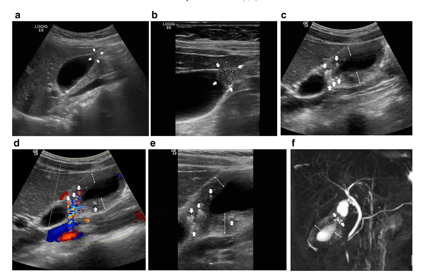 【Incidental Findings of Gallbladder and Bile Ducts-Management Strategies: General Aspects, Gallbladder Polyps and Gallbladder Wall Thickening-A World Federation of Ultrasound in Medicine and Biology (WFUMB) Position Paper】Ultrasound and MRCP