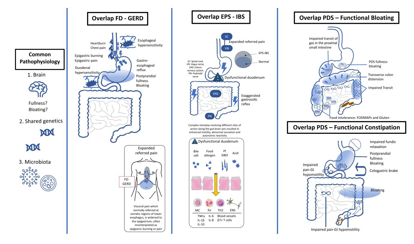 【Asia-Pacific guidelines for managing functional dyspepsia overlapping with other gastrointestinal symptoms】Pathophysiology Infographic
