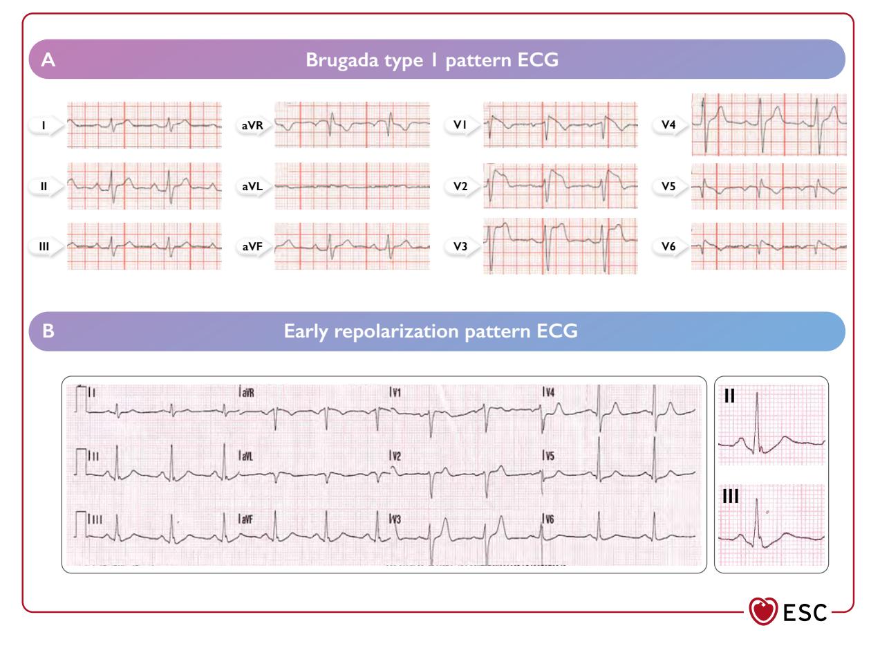 【2022 ESC Guidelines for the management of patients with ventricular arrhythmias and the prevention of sudden cardiac death】Electrocardiogram (ECG)