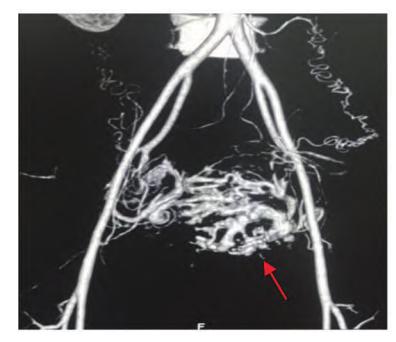image_category: MEDICAL_IMAGING/CTA/MRA 3D重建 | body_region: 盆腔 | specialty: 放射科 | summary: 盆腔内可见巨大且复杂的异常血管团块,提示严重的盆腔动静脉畸形(AVM)。 | detail: 该图为盆腔血管系统的三维重建影像(CTA或MRA)。视觉上可见腹主动脉末端及其分叉形成的双侧髂总动脉、髂内及髂外动脉。在盆腔中心区域,存在一个巨大的、呈乱麻状缠绕的异常血管丛,其形态高度迂曲且管径不一。红色箭头精准指向该血管畸形团的底部边缘。医学发现显示,该区域血供异常丰富,存在明显的动静脉短路征象。临床意义上,此类盆腔动静脉畸形(AVM)可能引发严重的慢性盆腔疼痛、顽固性子宫出血或因高动力循环导致的心力衰竭。关键数据点在于畸形血管团占据了盆腔的大部分空间,且供血动脉明显增粗。 | entities: diseases=盆腔动静脉畸形, 血管畸形; anatomical_structures=腹主动脉, 髂总动脉, 髂内动脉, 髂外动脉, 盆腔血管; interventions=血管造影术; findings=巨大异常血管团, 血管迂曲扩张, 红色箭头指示病灶位置