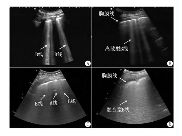 【急性呼吸困难床旁肺超声诊断规范专家建议】肺部超声
