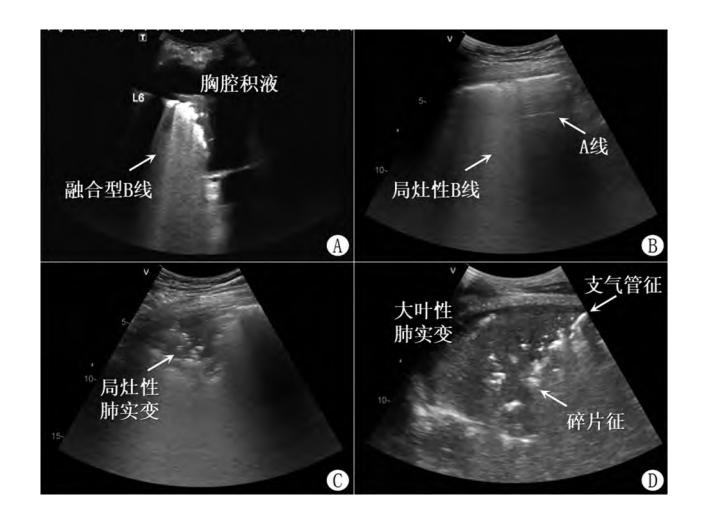 【急性呼吸困难床旁肺超声诊断规范专家建议】肺部超声