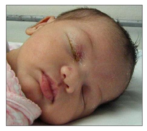 【Perinatal Services BC Guideline: Prevention and Management of Ophthalmia Neonatorum Caused by Chlamydia trachomatis and Neisseria gonorrhoeae】Clinical photograph
