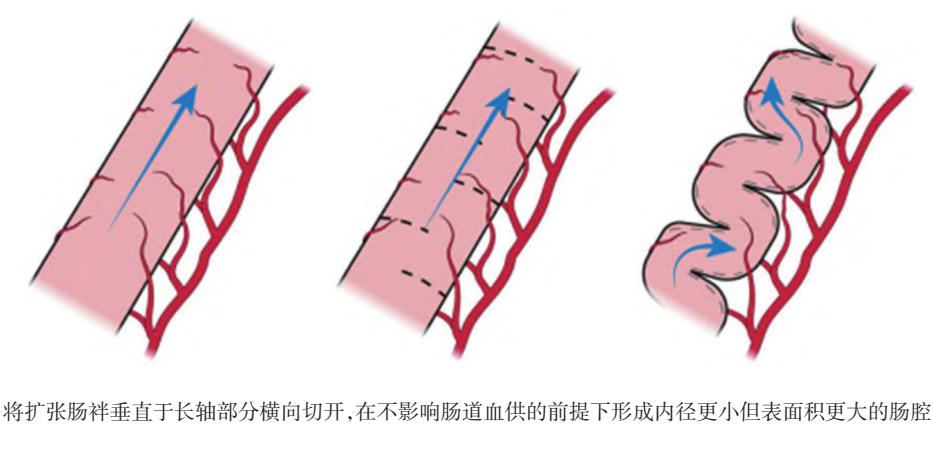 【手术示意图】body...