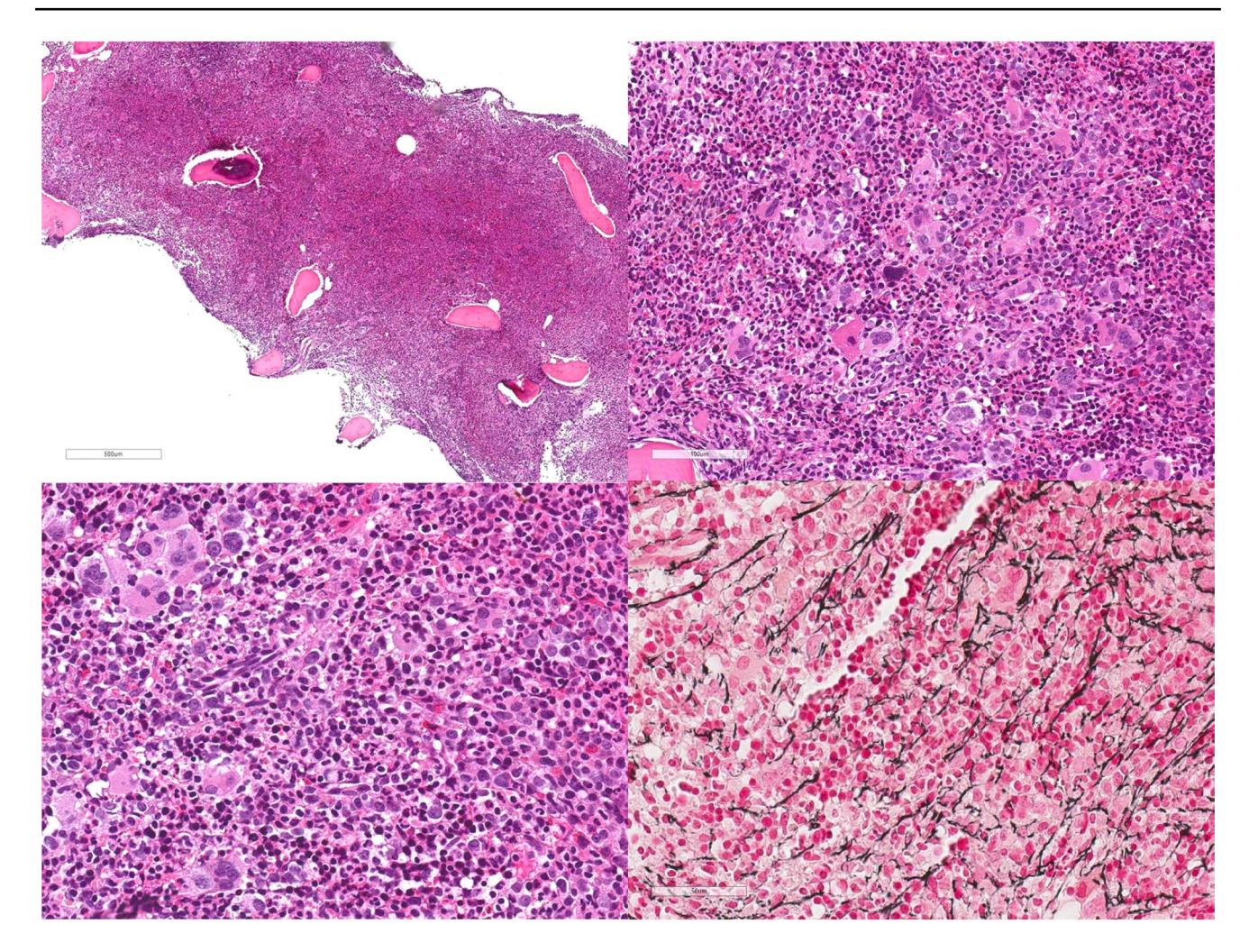 【International Consensus Classification of myeloid and lymphoid neoplasms: myeloproliferative neoplasms】Bone marrow biopsy