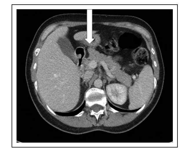 【 Recommendations for the management of incidental pancreatic findings in adults by the Canadian Association of Radiologists Incidental Findings Working Group】CT scan