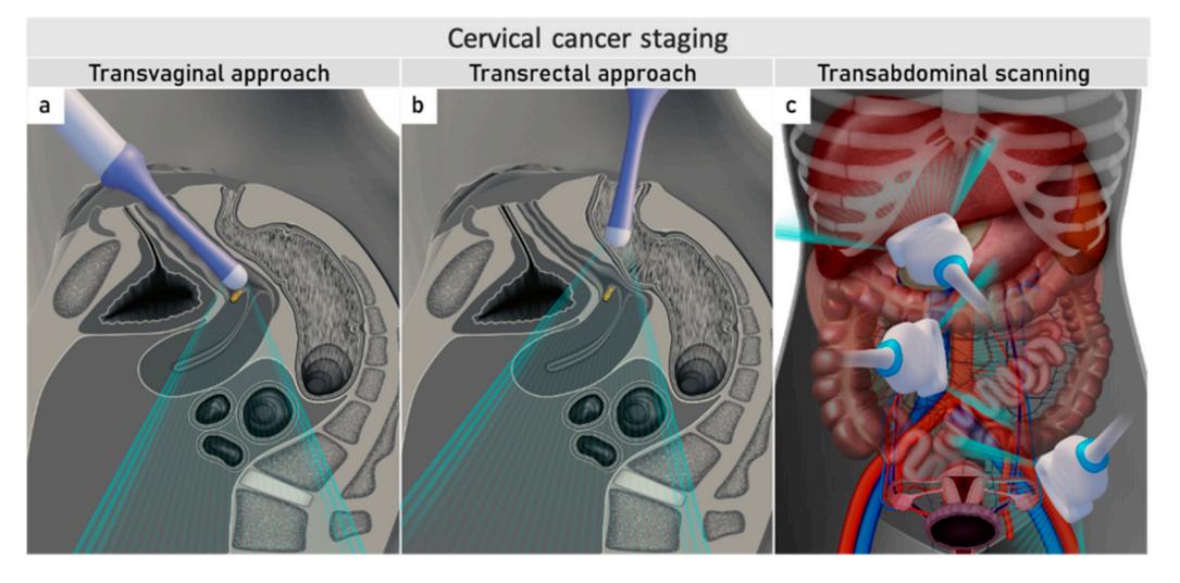 image_category: DIAGRAM/Ultrasound imaging techniques illustration | body_region: pelvis/abdomen | specialty: Radiology | summary: Illustration of transvaginal, transrectal, and transabdominal ultrasound approaches used for cervical cancer staging.