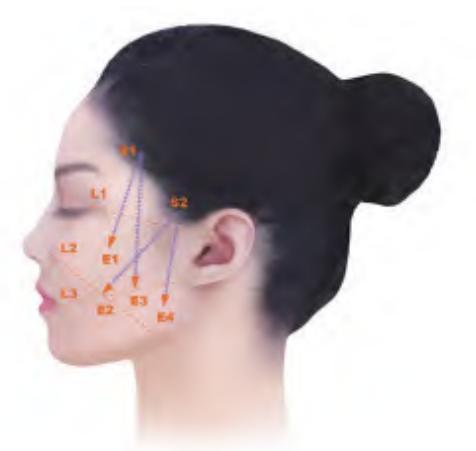 image_category: CLINICAL_PHOTO/面部提升矢量示意图 | body_region: 头 | specialty: 医疗美容科/整形外科 | summary: 该图展示了面部年轻化治疗(如线雕或注射提升)中的关键解剖位点与提升矢量设计。 | detail: 图片展示了一名女性面部的左侧位示意图,详细标注了面部提升手术或微整形注射中的矢量路径与解剖参考点。图中包含蓝色和橙色两组标注:S1、S2(蓝色)位于颞部和耳前区域,通常作为悬吊提升的锚定点或起始区;E1至E4(橙色)分布在面颊及下颌区域,代表提升矢量的终点或受力点。蓝色箭头清晰指示了从上方固定区向下方松弛区的拉力方向,旨在改善鼻唇沟、木偶纹及下颌缘轮廓。橙色标注L1-L3及虚线勾勒出面部解剖分区,可能对应面部韧带分布或脂肪室边界。此图对于临床制定面部提升方案、确定进针点及布线层次具有重要的指导意义,体现了生物力学在面部年轻化中的应用。 | entities: diseases=面部皮肤松弛, 鼻唇沟加深, 下颌缘模糊; anatomical_structures=面部, 颞部, 颊部, 下颌缘, 耳前区; interventions=面部提升术, 埋线提升, 矢量注射, 微整形; findings=S1/S2:上方锚定/悬吊起始点, E1-E4:下方提升目标/受力点, 蓝色箭头:提升矢量方向, 橙色虚线:解剖分区/韧带线