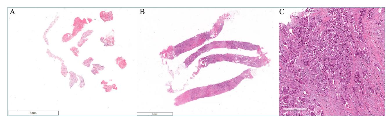 image_category: PATHOLOGY/H&E stained histopathology | body_region: NA | specialty: Pathology | summary: Histopathological sections of a core needle biopsy demonstrating invasive carcinoma with nested and cord-like growth patterns. | detail: This image presents three panels (A, B, and C) of H&E stained histopathological sections. Panel A shows multiple small tissue fragments at low magnification, with a scale bar indicating 5mm. Panel B displays several needle core biopsy specimens at a similar low magnification (scale bar 5mm), showing dense, hypercellular areas stained dark purple, suggesting high nuclear density. Panel C provides a high-magnification view (scale bar 200µm) of the lesion. It reveals an infiltrative growth of malignant epithelial cells arranged in irregular nests, solid clusters, and cords. The tumor cells exhibit prominent cytological atypia, including enlarged, pleomorphic, and hyperchromatic nuclei with conspicuous nucleoli. The malignant cells are embedded within a desmoplastic fibrous stroma. These features are characteristic of an invasive carcinoma, such as invasive ductal carcinoma. The clinical significance lies in the definitive diagnosis of malignancy from the core biopsy, which is essential for staging and determining the therapeutic approach, such as surgery, chemotherapy, or radiotherapy. The presence of infiltrative nests confirms the invasive nature of the tumor. | entities: diseases=invasive carcinoma, malignancy, invasive ductal carcinoma; anatomical_structures=epithelial cells, fibrous stroma, nuclei; interventions=core needle biopsy; biomarkers=H&E stain; findings=nested growth pattern, cord-like growth, hyperchromatic nuclei, pleomorphism, infiltrative growth, desmoplastic stroma, scale bar A: 5mm, scale bar B: 5mm, scale bar C: 200µm | measurements: scale bar A 5 mm; scale bar B 5 mm; scale bar C 200 µm