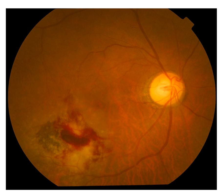 【湿性AMD】黄斑区大片视网膜下出血及渗出