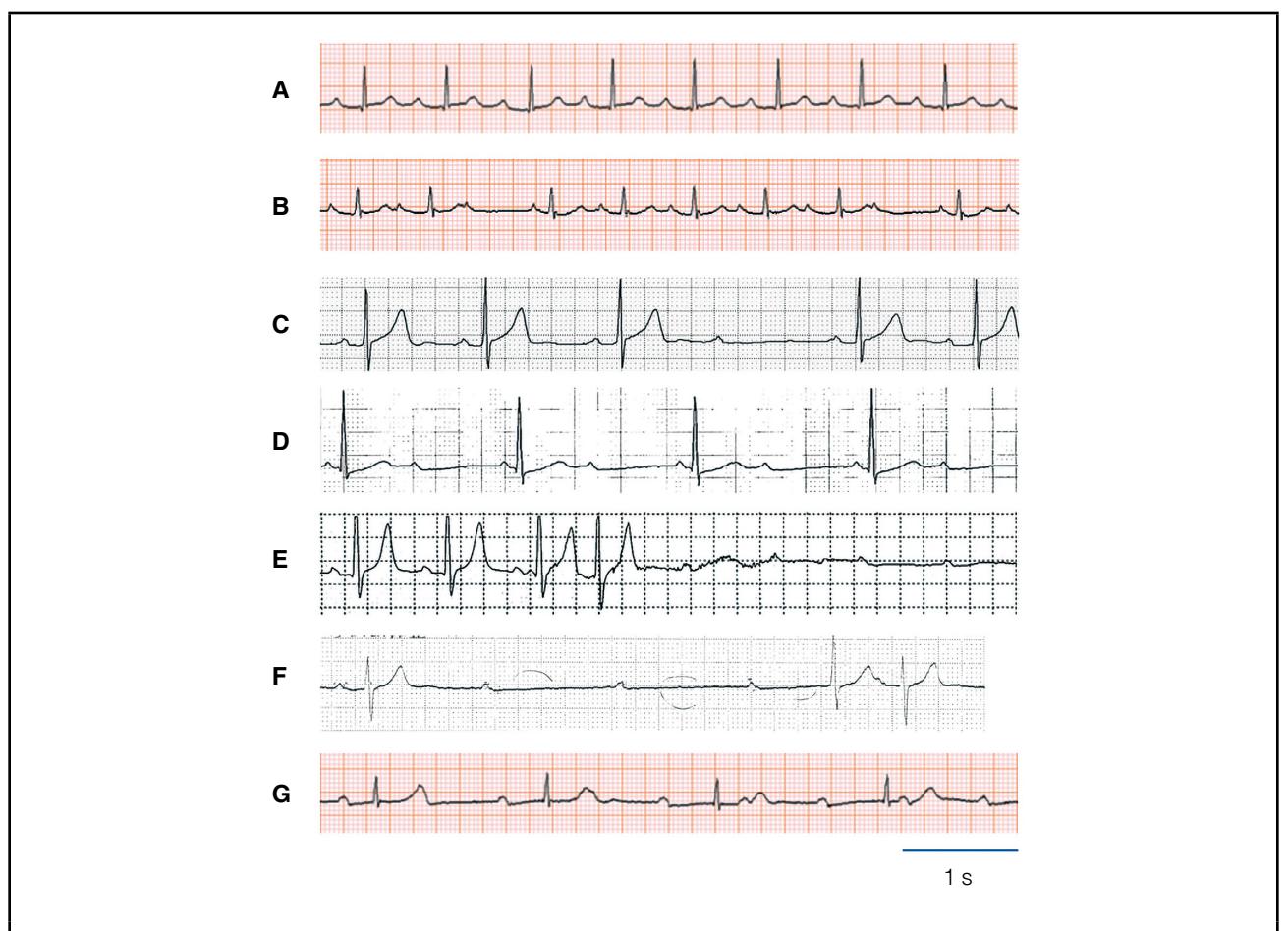 【JCS/JHRS 2022 Guideline on Diagnosis and Risk Assessment of Arrhythmia】Electrocardiogram (ECG)